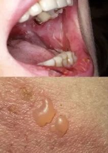 מחלות אוטואימוניות של העור וריריות הפה