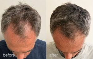 טיפולי PRP משולבי לייזר בנשירת שיער